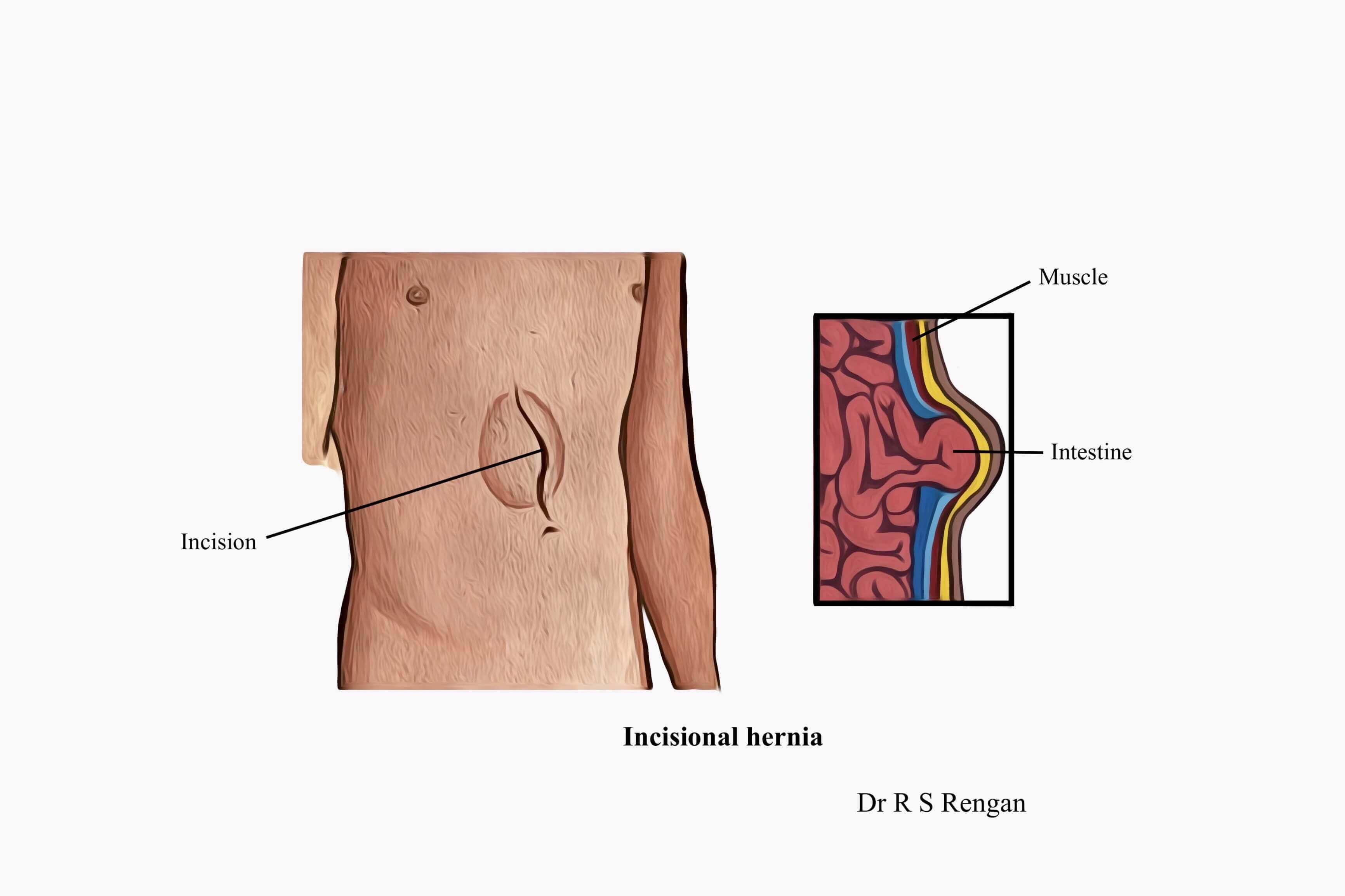 Incisional Hernia surgery