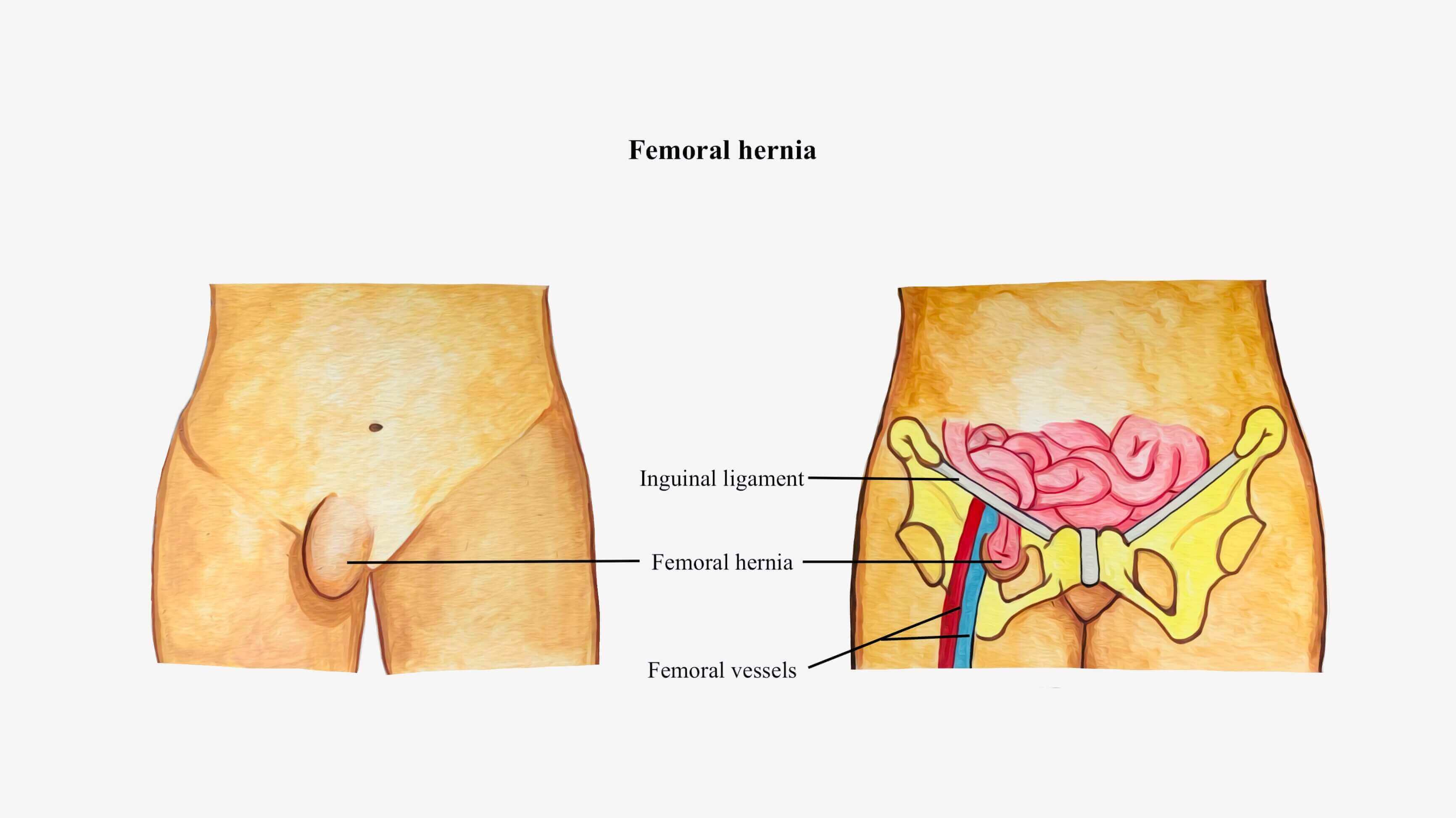 Do inguinal and femoral hernias require two separate surgeries